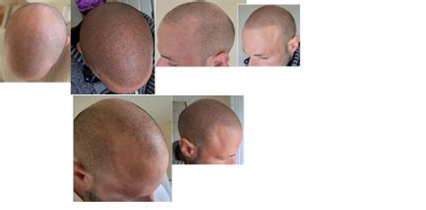 scalp micropigmentation forum.